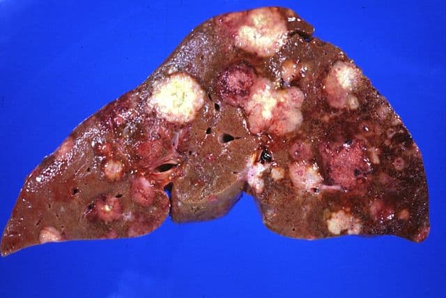 यकृत रोग Liver disease