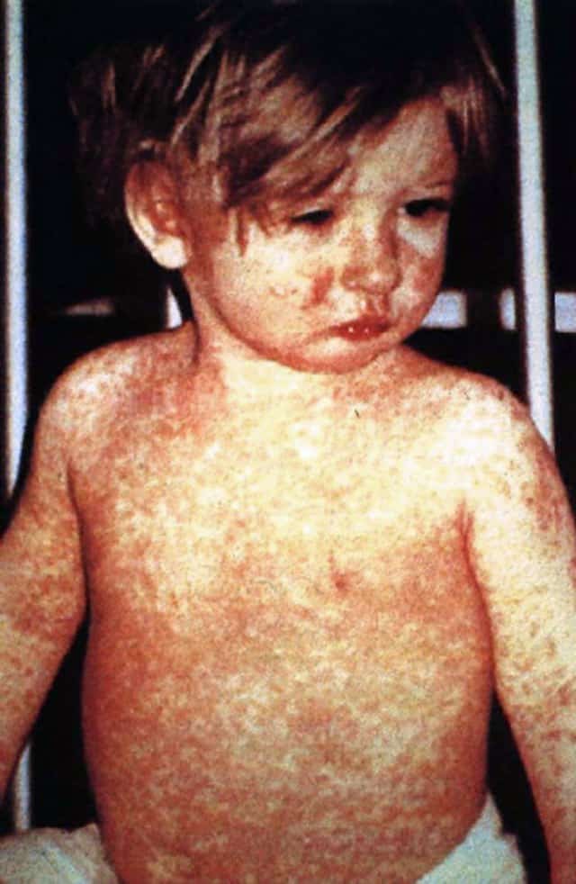 खसरा Measles
