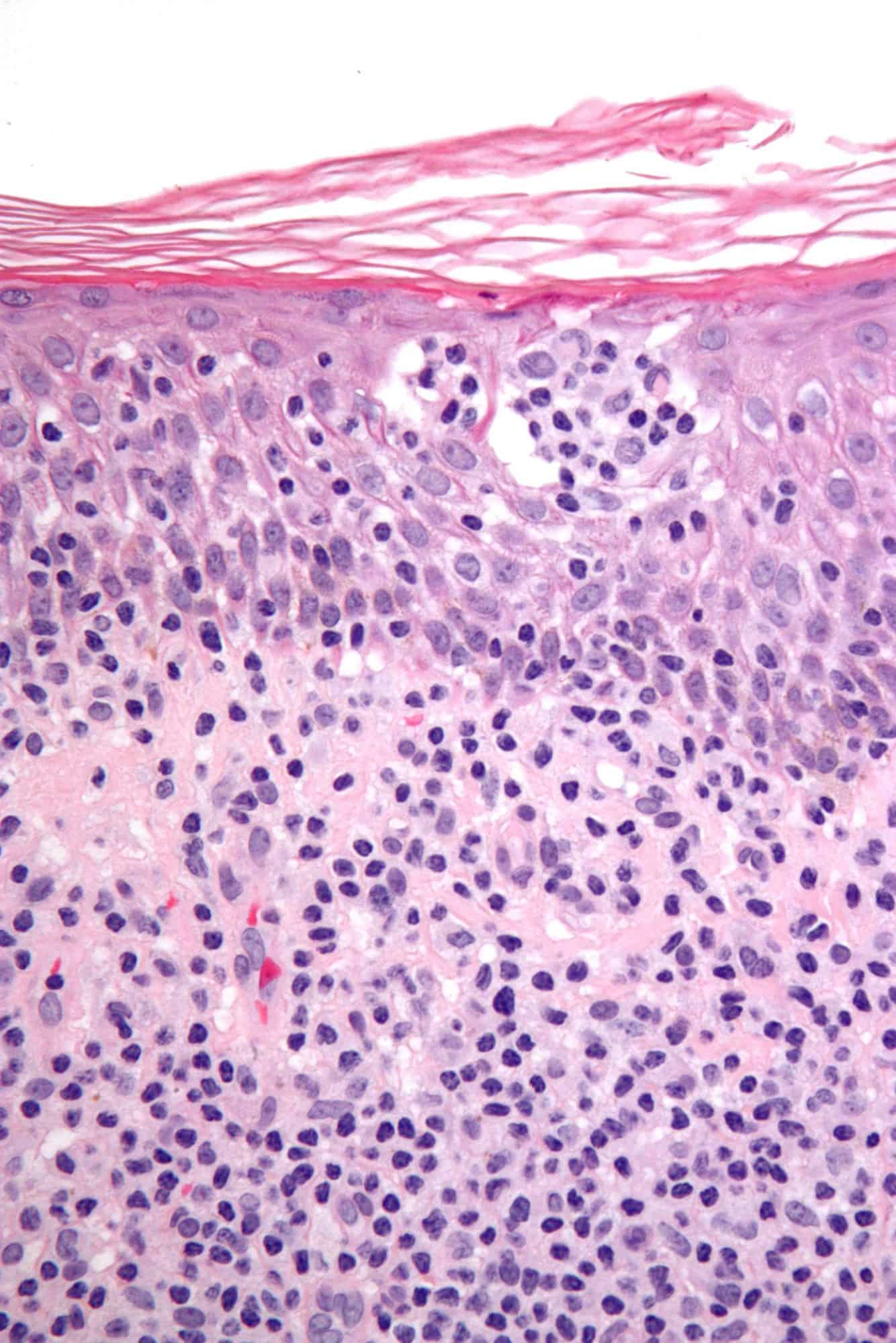 Cutaneous T-Cell Lymphomas