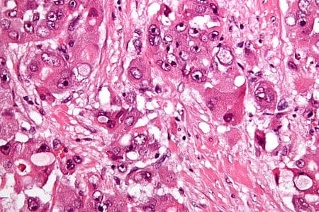 Fibrolamellar hepatocellular carcinoma