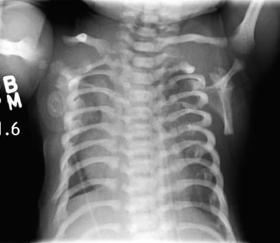 Asphyxiating Thoracic Dystrophy