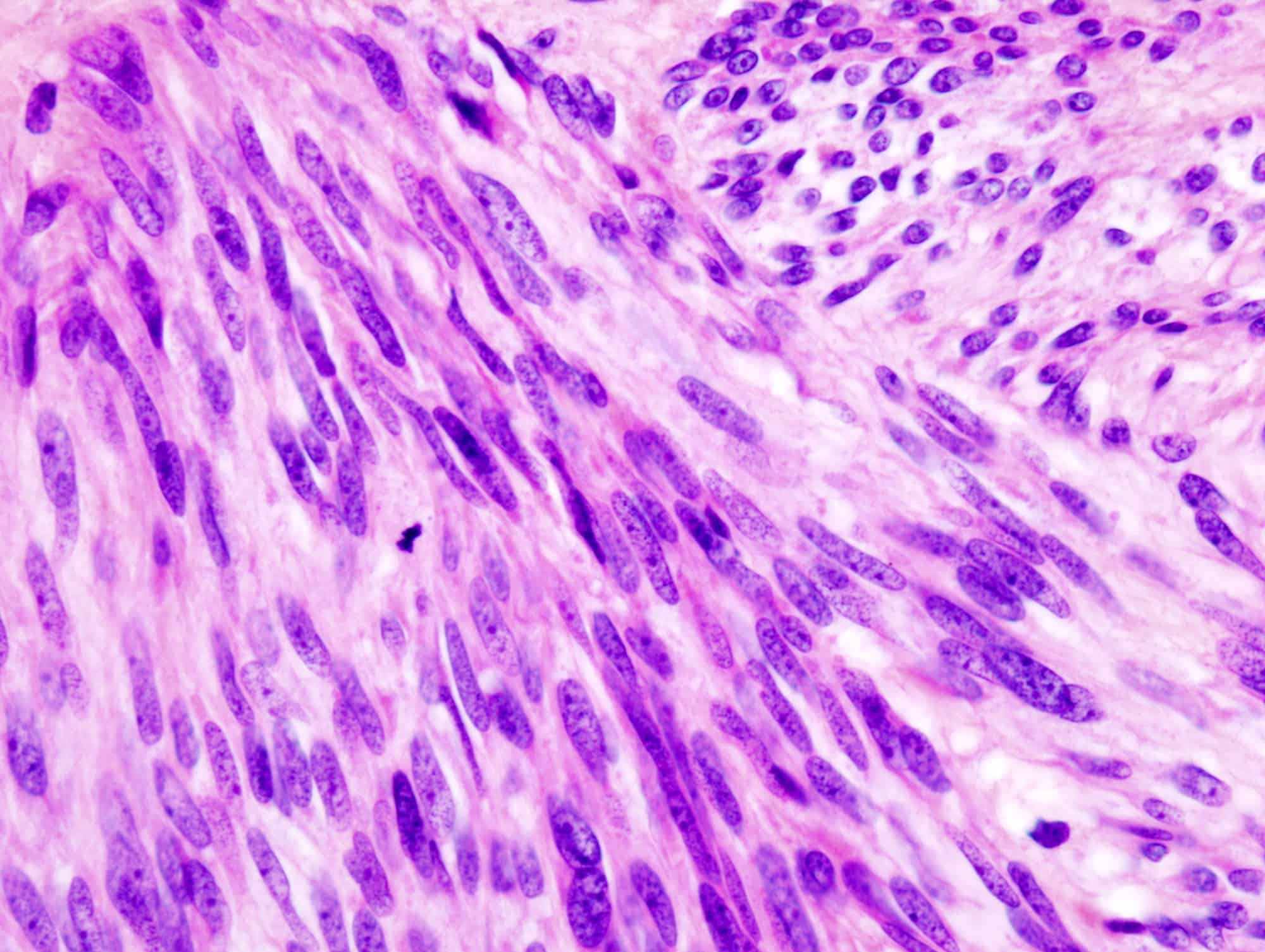 Gastrointestinal Stromal Tumors