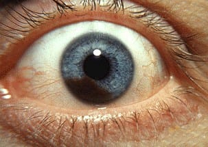 Ocular Melanoma